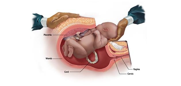 Caesarean Section