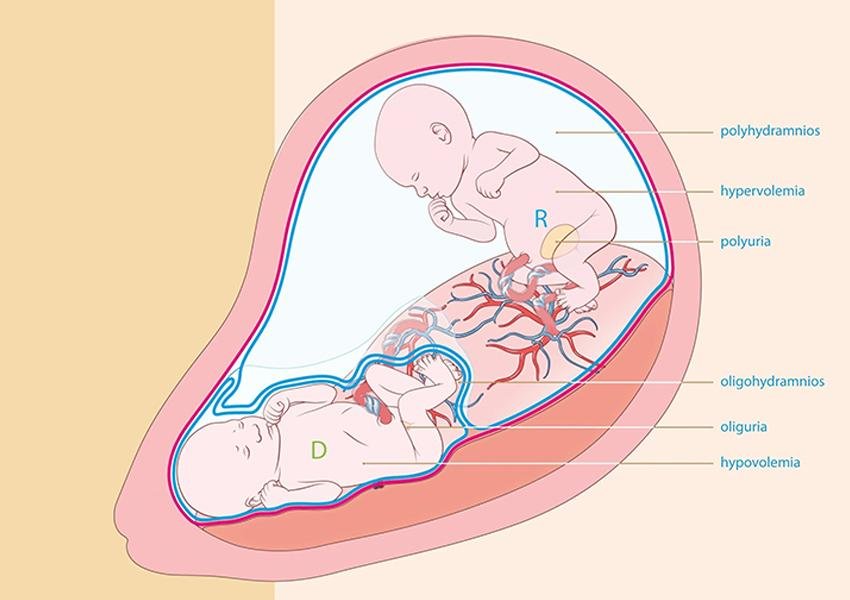 Monochorionic twins (Identical twins)